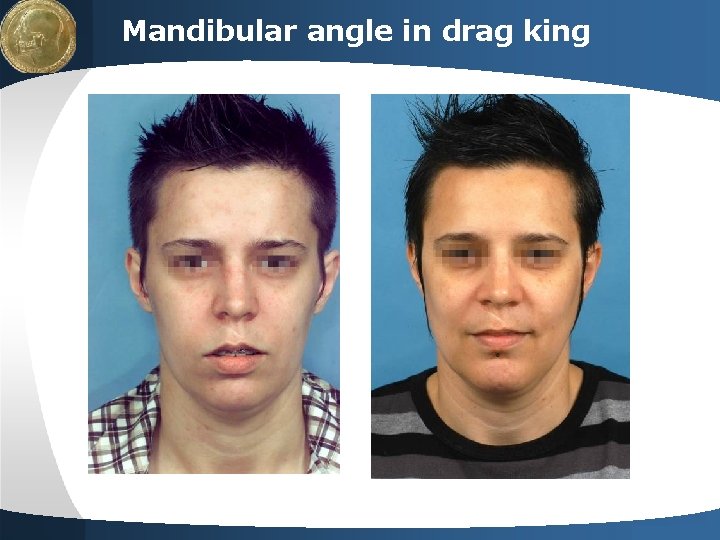 LOGO Mandibular angle in drag king Your site here 