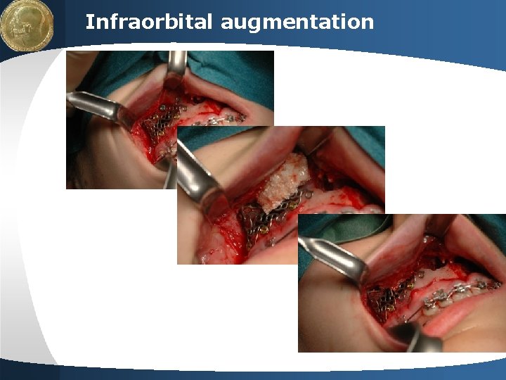 LOGO Infraorbital augmentation Your site here 