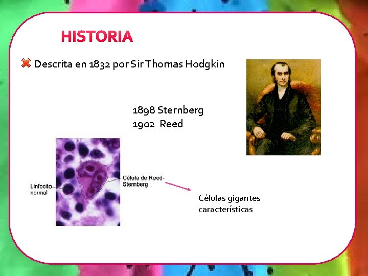 HISTORIA Descrita en 1832 por Sir Thomas Hodgkin 1898 Sternberg 1902 Reed Células gigantes