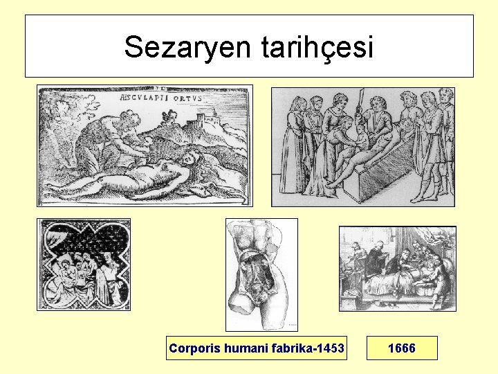 Sezaryen tarihçesi Corporis humani fabrika-1453 1666 
