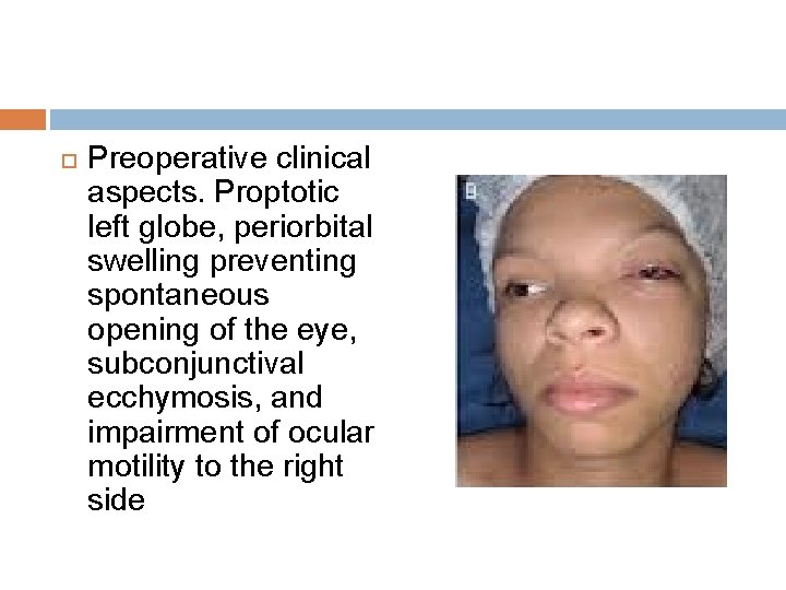  Preoperative clinical aspects. Proptotic left globe, periorbital swelling preventing spontaneous opening of the