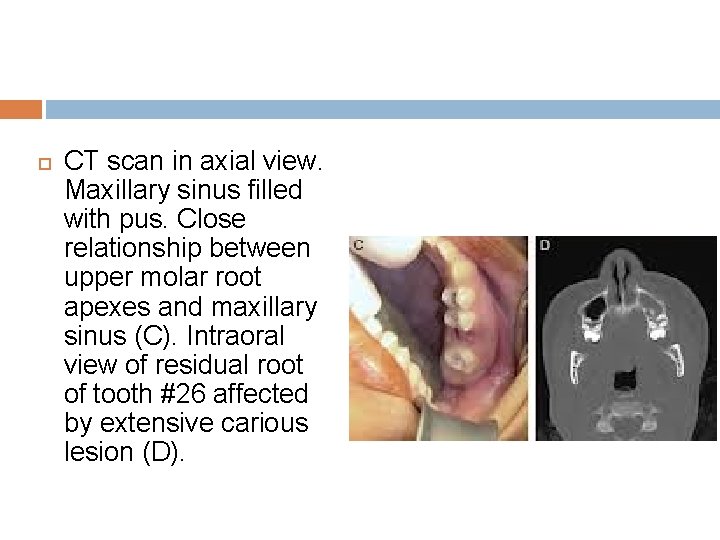  CT scan in axial view. Maxillary sinus filled with pus. Close relationship between