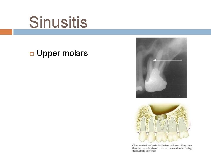 Sinusitis Upper molars 
