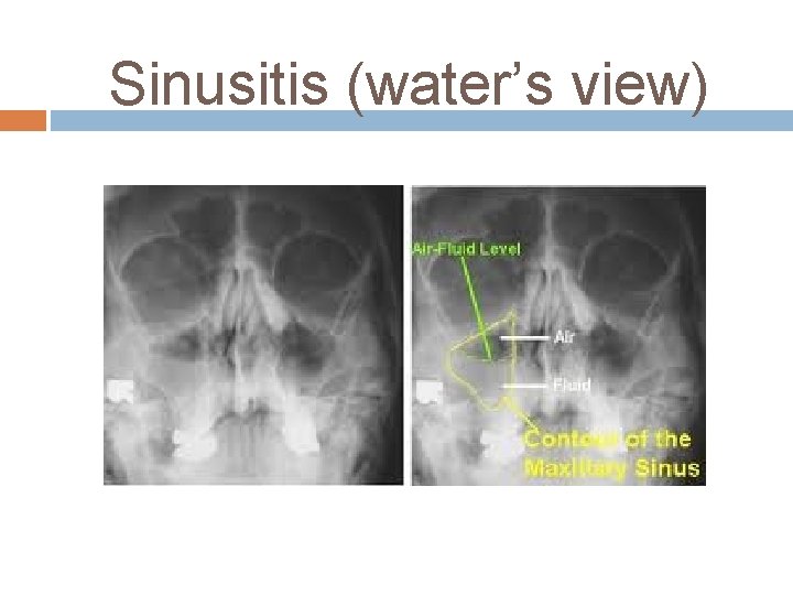 Sinusitis (water’s view) 