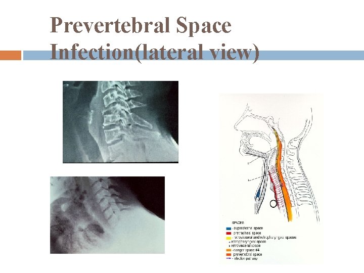 Prevertebral Space Infection(lateral view) 