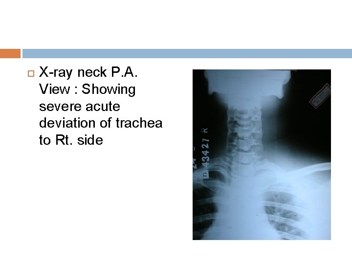  X-ray neck P. A. View : Showing severe acute deviation of trachea to