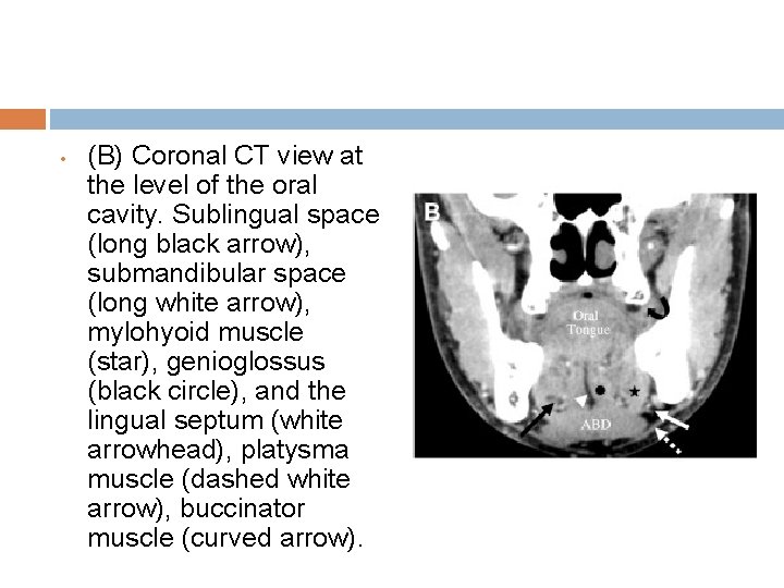  • (B) Coronal CT view at the level of the oral cavity. Sublingual