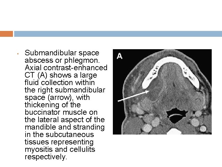 • Submandibular space abscess or phlegmon. Axial contrast-enhanced CT (A) shows a large