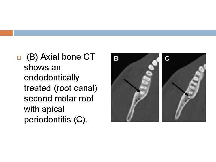  (B) Axial bone CT shows an endodontically treated (root canal) second molar root