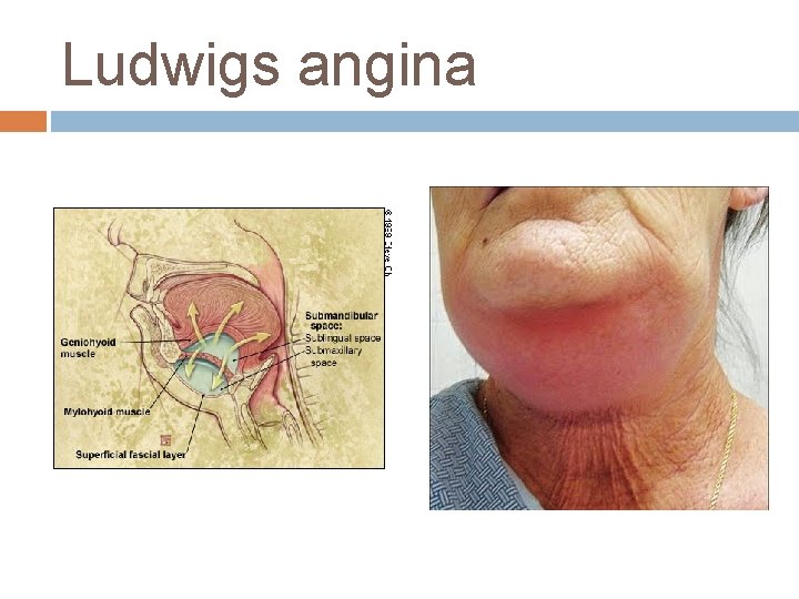 Ludwigs angina 