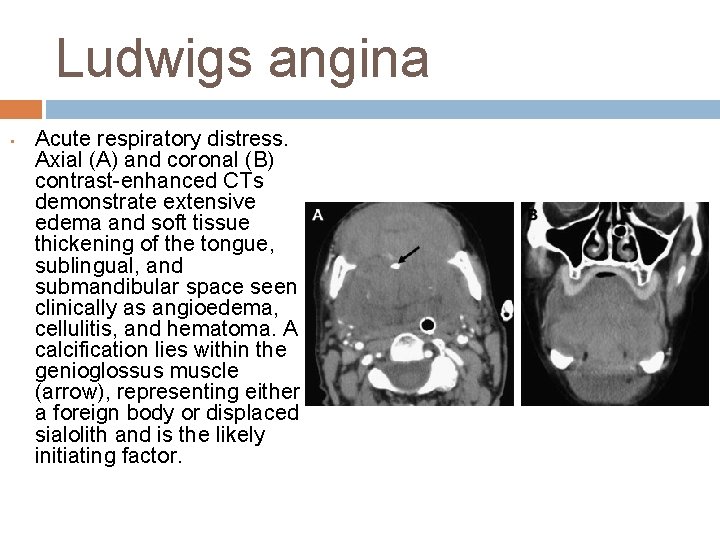 Ludwigs angina • Acute respiratory distress. Axial (A) and coronal (B) contrast-enhanced CTs demonstrate