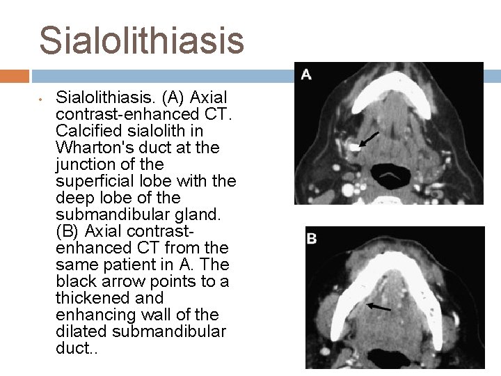 Sialolithiasis • Sialolithiasis. (A) Axial contrast-enhanced CT. Calcified sialolith in Wharton's duct at the