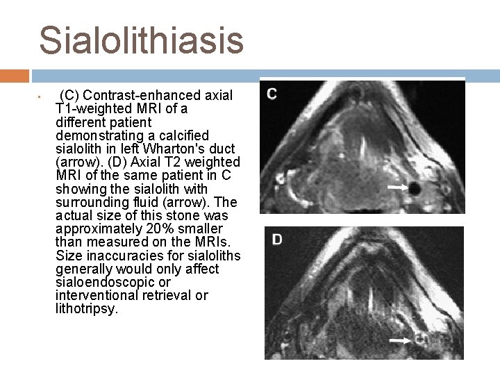 Sialolithiasis • (C) Contrast-enhanced axial T 1 -weighted MRI of a different patient demonstrating