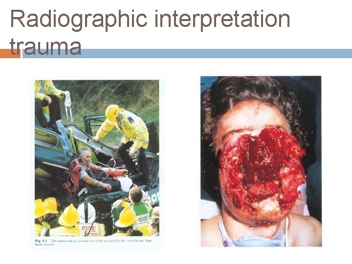 Radiographic interpretation trauma 