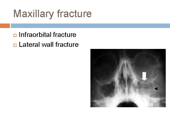 Maxillary fracture Infraorbital fracture Lateral wall fracture 