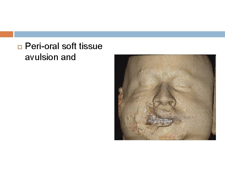  Peri-oral soft tissue avulsion and 