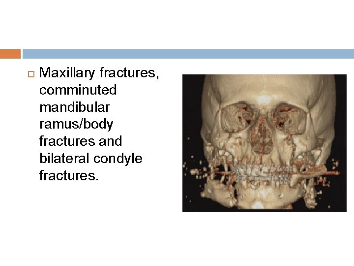  Maxillary fractures, comminuted mandibular ramus/body fractures and bilateral condyle fractures. 