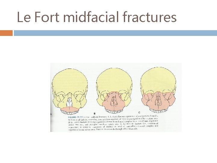 Le Fort midfacial fractures 