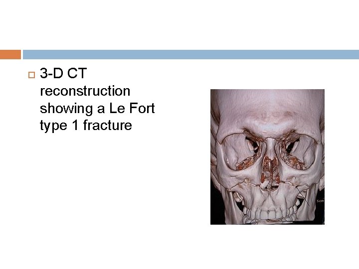  3 -D CT reconstruction showing a Le Fort type 1 fracture 
