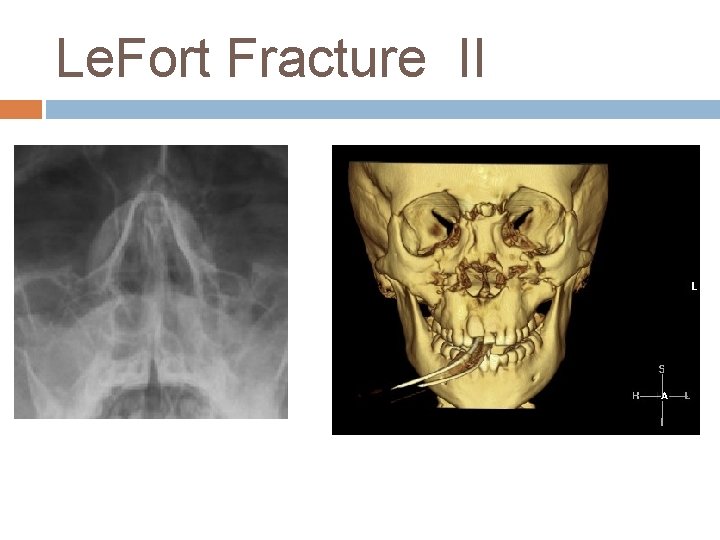 Le. Fort Fracture II 