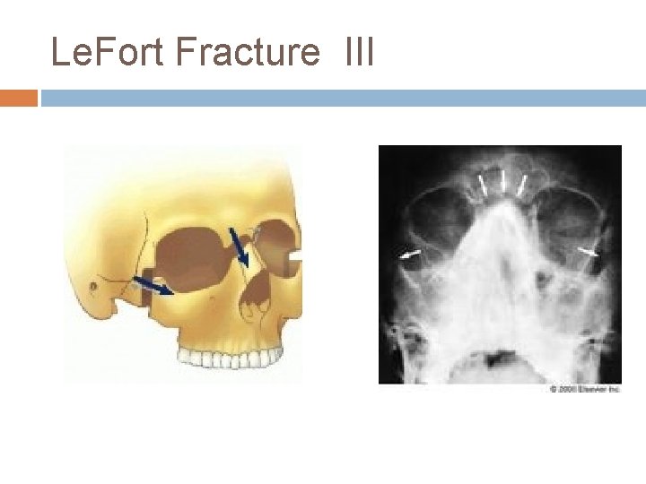 Le. Fort Fracture III 