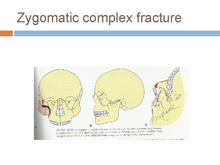 Zygomatic complex fracture 