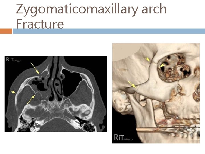 Zygomaticomaxillary arch Fracture 