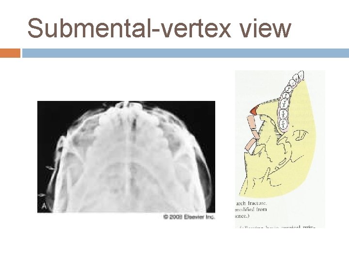Submental-vertex view 