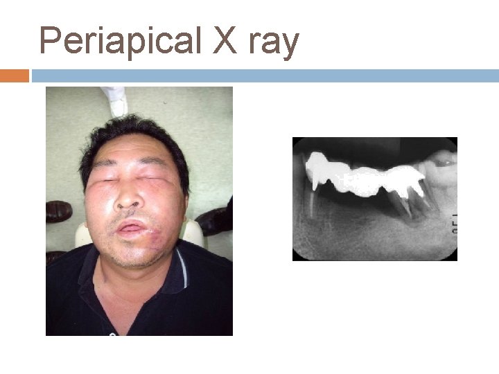 Periapical X ray 