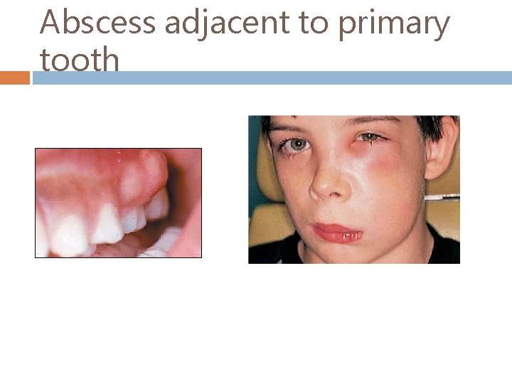 Abscess adjacent to primary tooth 