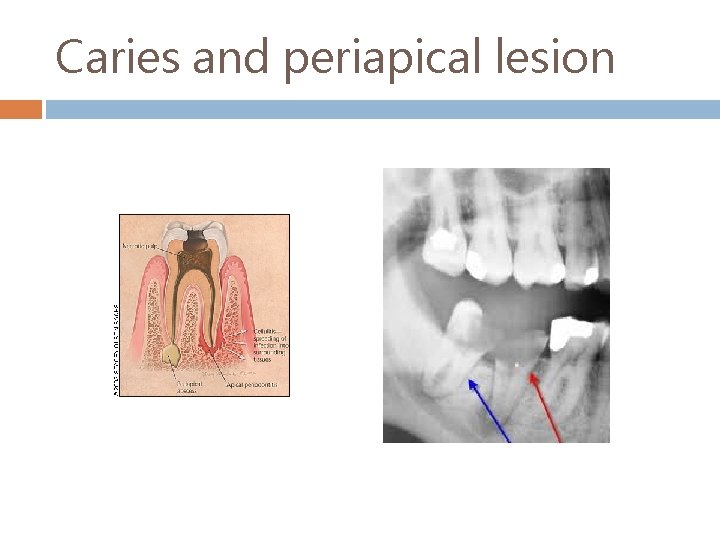 Caries and periapical lesion 