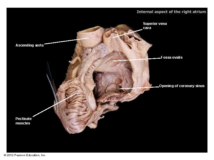 Superior vena cava Ascending aorta Fossa ovalis Opening of coronary sinus Pectinate muscles ©