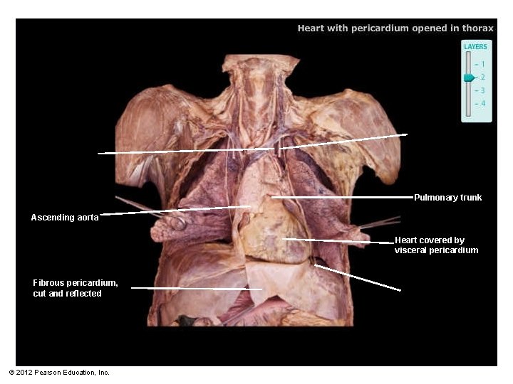 Pulmonary trunk Ascending aorta Heart covered by visceral pericardium Fibrous pericardium, cut and reflected