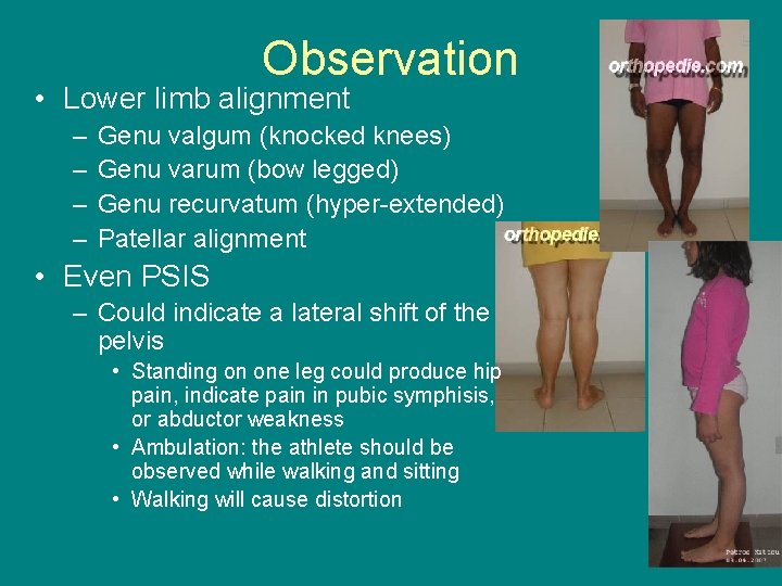 Observation • Lower limb alignment – – Genu valgum (knocked knees) Genu varum (bow