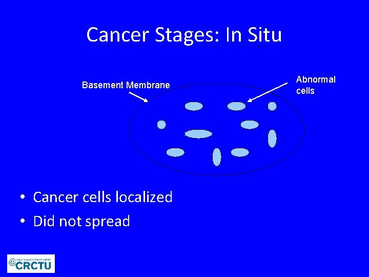 Cancer Stages: In Situ Basement Membrane • Cancer cells localized • Did not spread