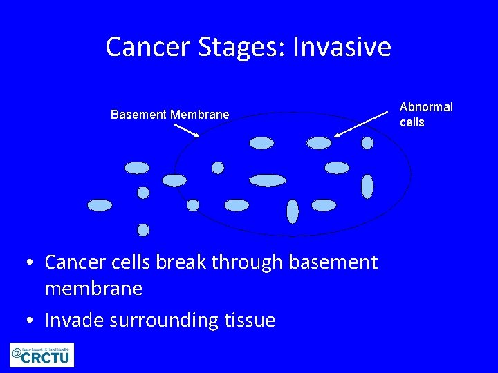 Cancer Stages: Invasive Basement Membrane • Cancer cells break through basement membrane • Invade