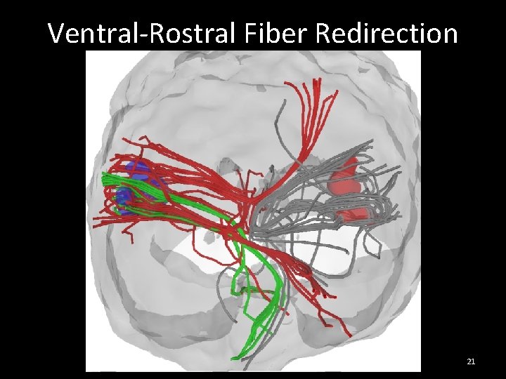 Ventral-Rostral Fiber Redirection 21 Ventral-Rostral Fiber Redirection 21