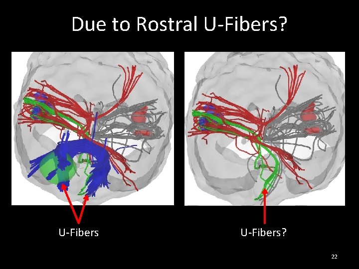 Due to Rostral U-Fibers? 22 Due to Rostral U-Fibers? 22