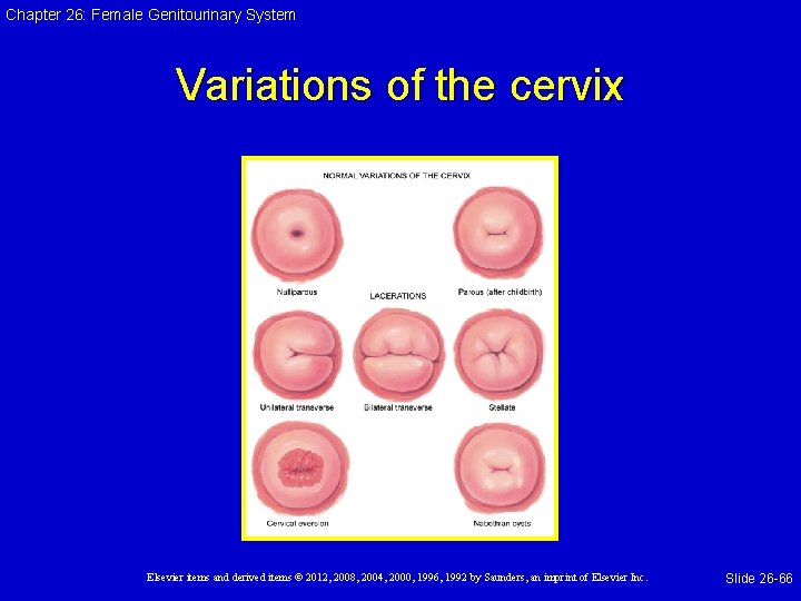 Chapter 26: Female Genitourinary System Variations of the cervix Elsevier items and derived items