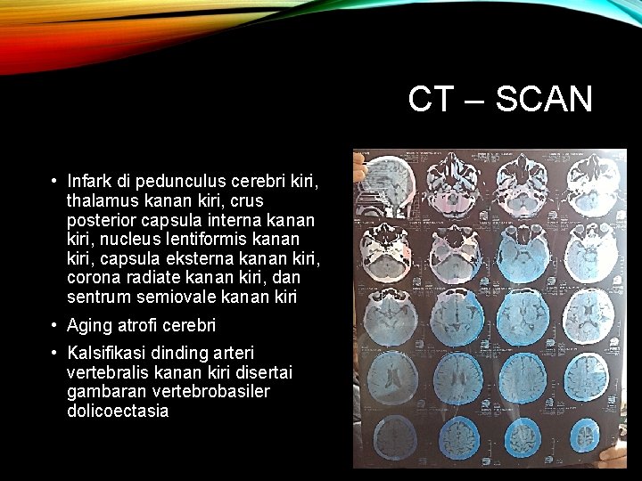 CT – SCAN • Infark di pedunculus cerebri kiri, thalamus kanan kiri, crus posterior CT – SCAN • Infark di pedunculus cerebri kiri, thalamus kanan kiri, crus posterior