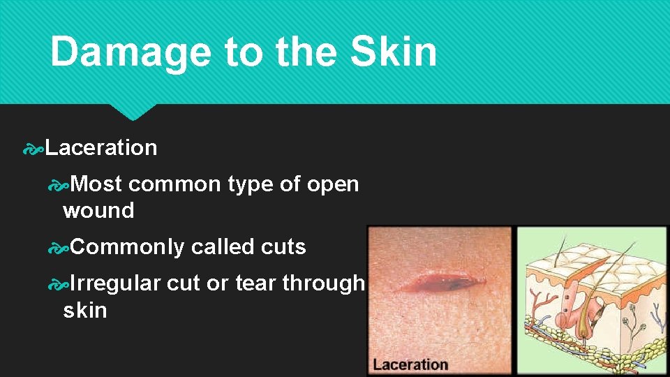 Damage to the Skin Laceration Most common type of open wound Commonly called cuts