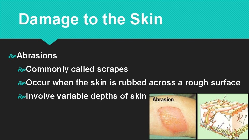 Damage to the Skin Abrasions Commonly called scrapes Occur when the skin is rubbed Damage to the Skin Abrasions Commonly called scrapes Occur when the skin is rubbed