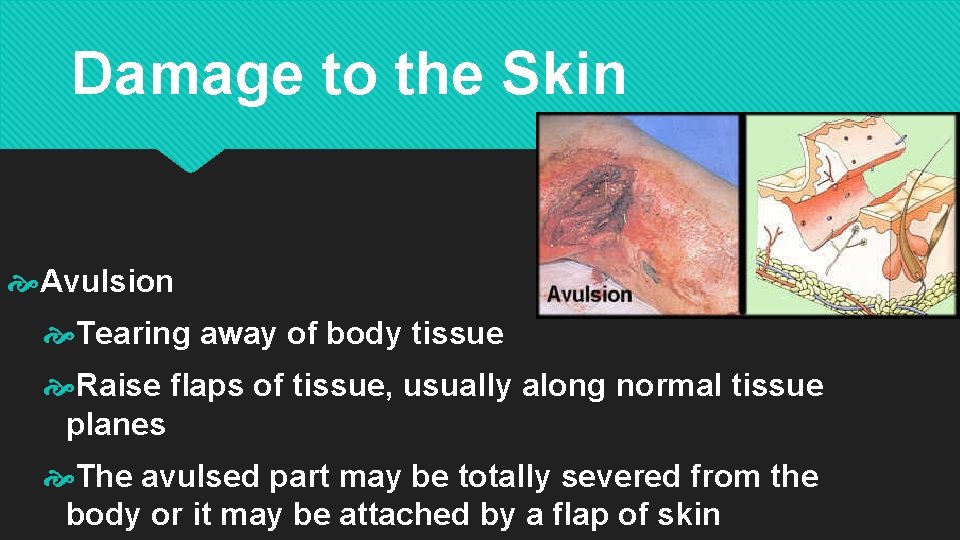 Damage to the Skin Avulsion Tearing away of body tissue Raise flaps of tissue,