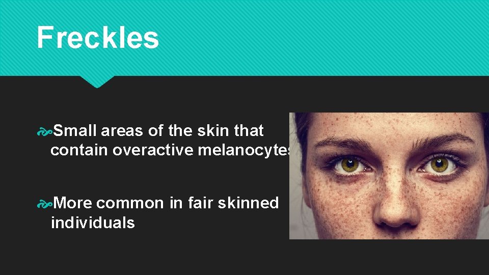 Freckles Small areas of the skin that contain overactive melanocytes More common in fair