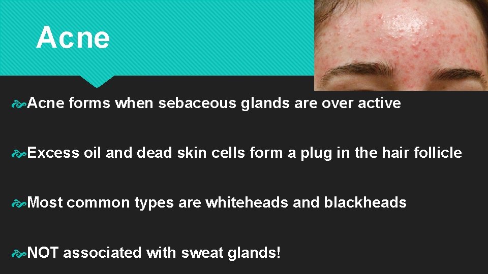 Acne forms when sebaceous glands are over active Excess oil and dead skin cells