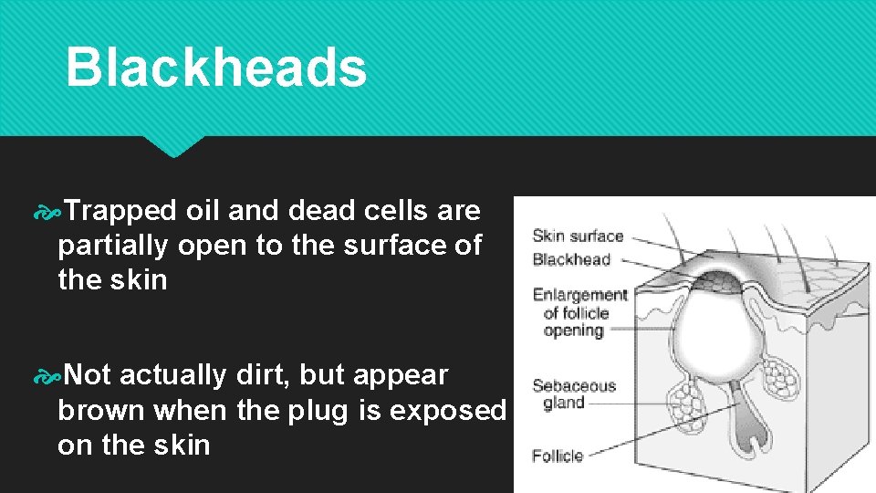 Blackheads Trapped oil and dead cells are partially open to the surface of the