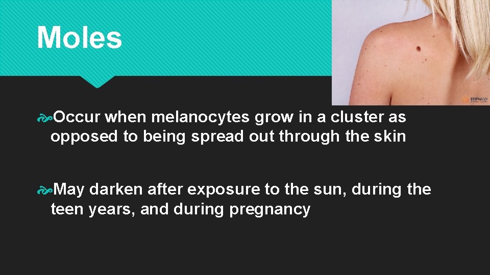 Moles Occur when melanocytes grow in a cluster as opposed to being spread out