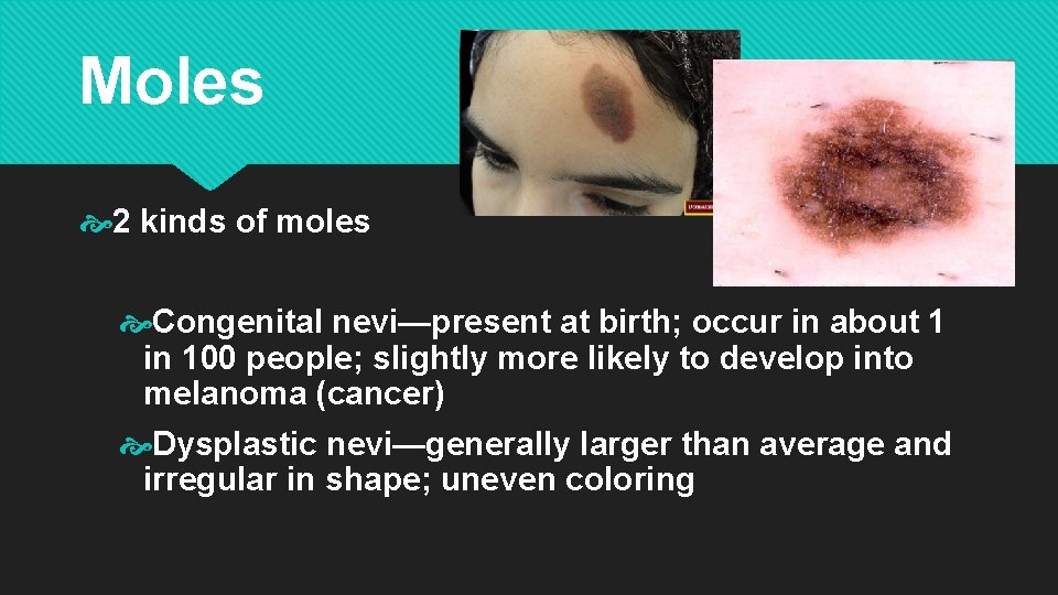 Moles 2 kinds of moles Congenital nevi—present at birth; occur in about 1 in