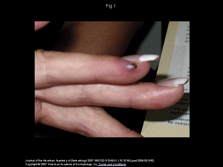 Fig 1 Journal of the American Academy of Dermatology 2007 56 S 122 -S