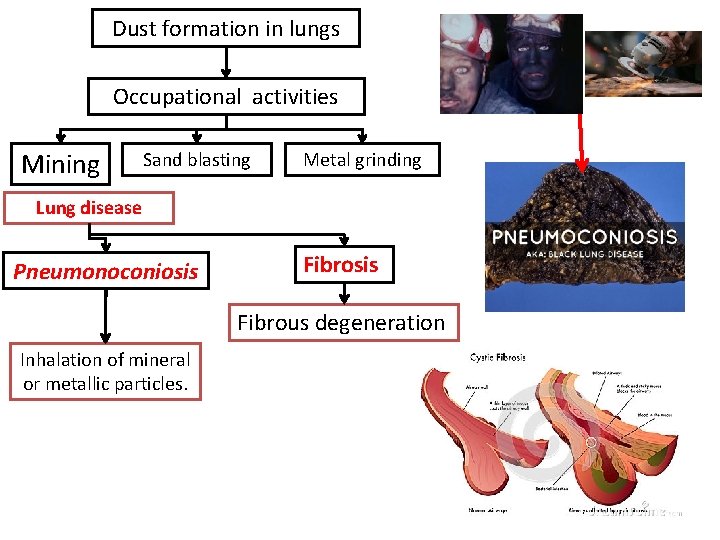 Dust formation in lungs Occupational activities Mining Sand blasting Metal grinding Lung disease Pneumonoconiosis